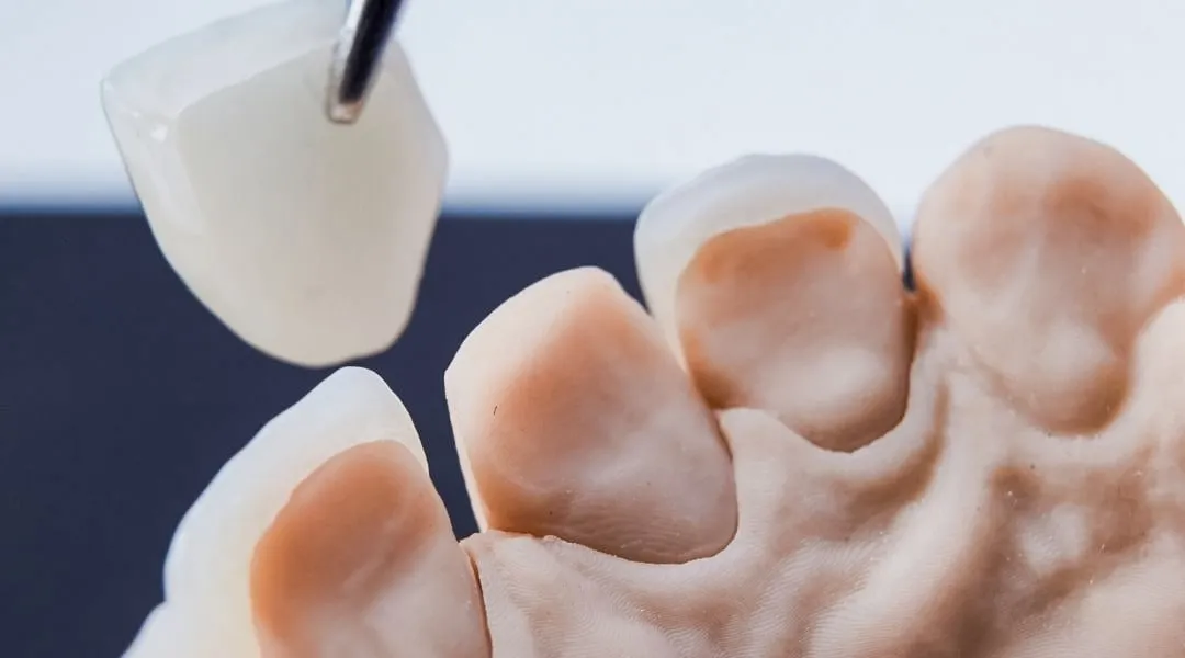 Uma pinça leva uma coroa de cerâmica a um modelo de gesso dos dentes.
