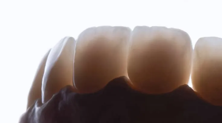 Um modelo da arcada com os dentes da prótese, contra a luz.